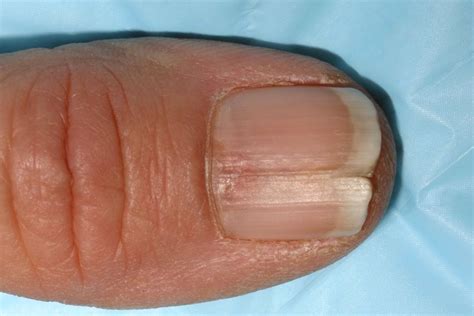 Some conditions need professional treatment from a doctor or a dermatologist. . Cn th nail